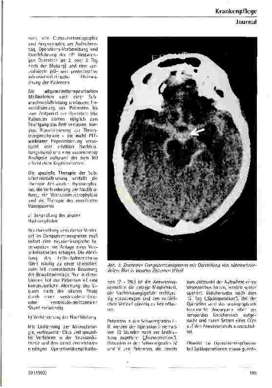 Vorschauseite 4: Subarachnoidalblutung - Pathophysiologie, Symptome und Therapie
