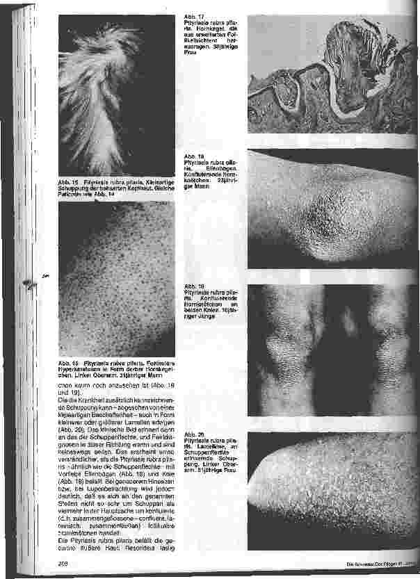 Vorschauseite 4: Hautärztliche Blickdiagnose von Erbkranheiten: Erbliche Verhornungsstörungen
