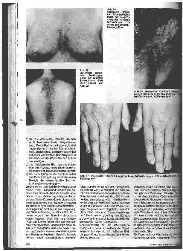 Vorschauseite 6: Hautärztliche Blickdiagnose von Erbkranheiten: Erbliche Verhornungsstörungen