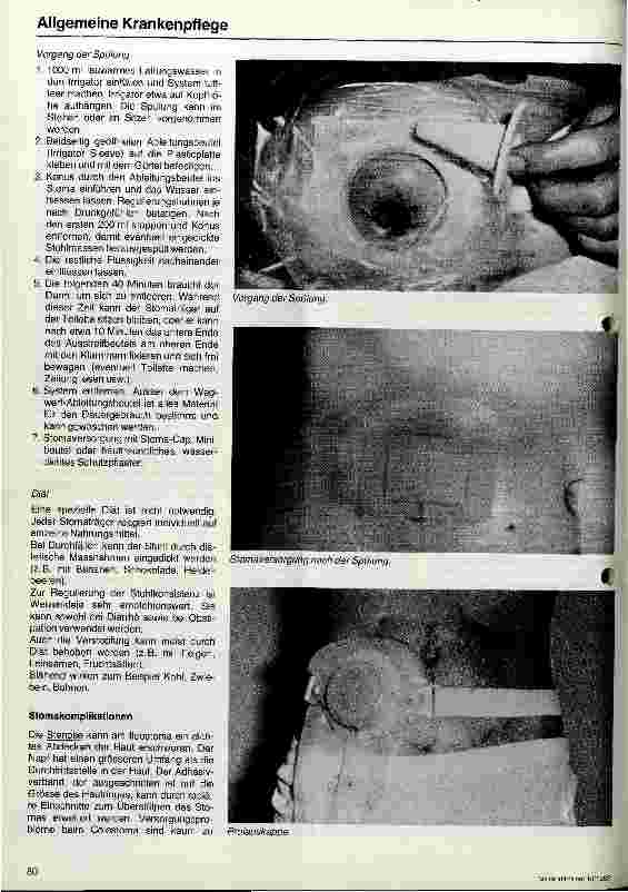 Vorschauseite 4: Betreuung und Pflege von Patienten mit einer Enterostomie Präoperative und postoperative Behandlung