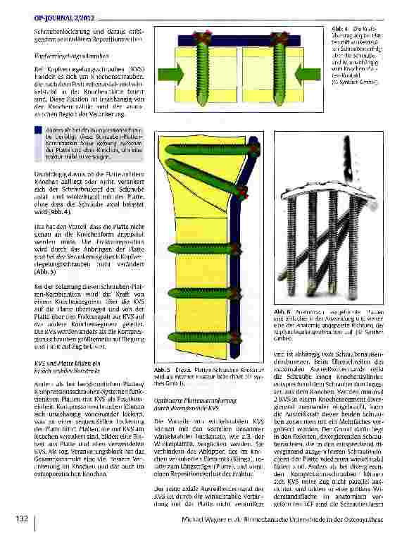 Vorschauseite 3: Biomechanische Unterschiede in der Osteosynthese zwischen Kompressionsplatten und Überbrückungsplatten