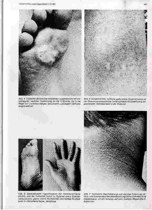 Vorschauseite 3: Verlaufsformen juveniler Hyperkeratosen