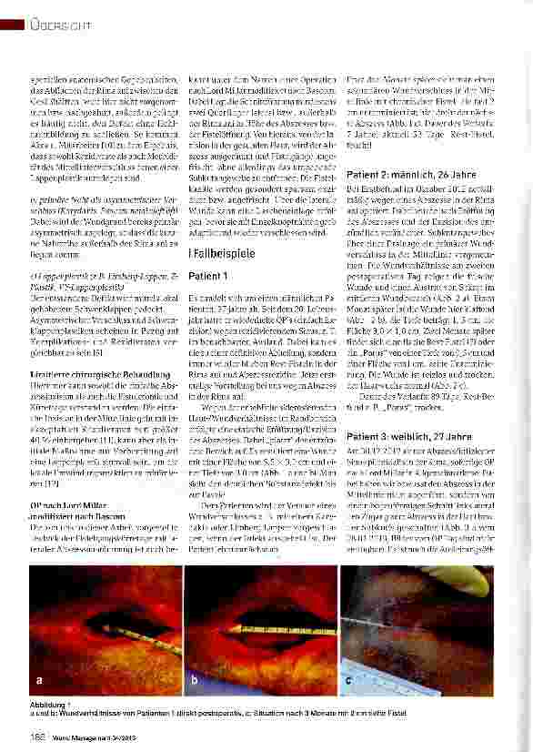 Vorschauseite 3: Sinus pilonidalis -Die OP nach Lord Millar als Alternativezur einfachen Exzision als Standardtherapie