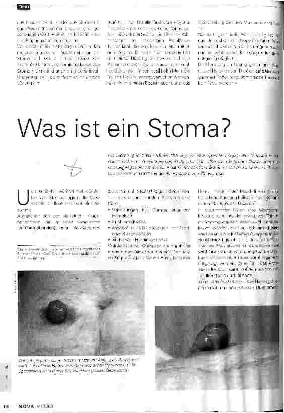 Vorschauseite 1: Was ist ein Stoma?