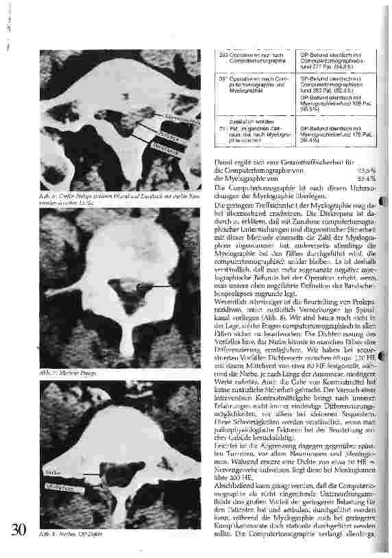 Vorschauseite 3: Die Bedeutung der Computertomographie in der Diagnostik des lumbalen Bandscheibenprolapses