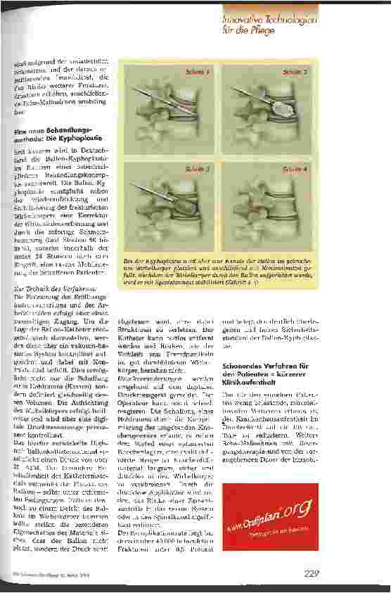 Vorschauseite 2: Kyphoplastie: Ein minimalinvasives Verfahren zur Behandlung von Wirbelfrakturen Osteoporose: Eine Krankheit auf dem Vormarsch