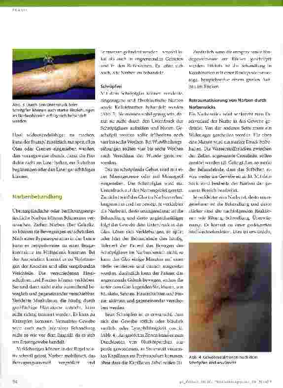 Vorschauseite 3: »Hand in Hand« - Prothesenversorgung und Physiotherapie bei AmputationspatientenTeil 7: Stumpfpflege, Abhärtung und Narbenbehandlung