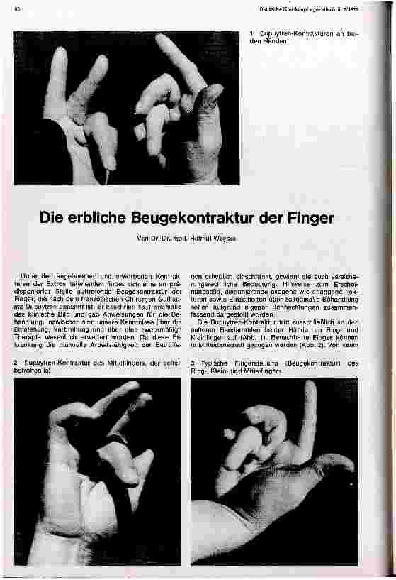 Vorschauseite 1: Die erbliche Beugekontraktur der Finger