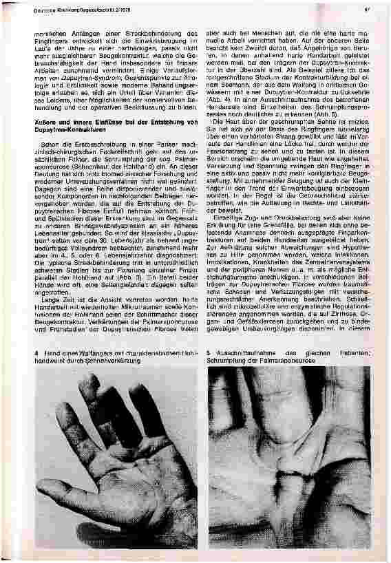 Vorschauseite 2: Die erbliche Beugekontraktur der Finger