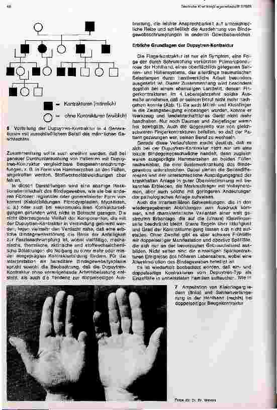 Vorschauseite 3: Die erbliche Beugekontraktur der Finger