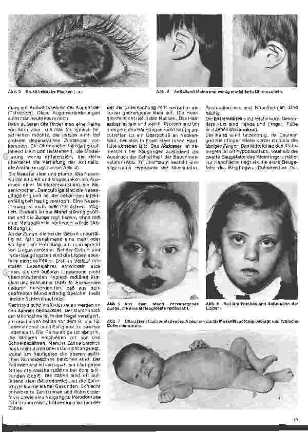 Vorschauseite 2: Kinderheilkunde Vererbte Krankheiten 4. Folge: Das Down-Syndrom (Mongolismus, Trisomie 21)
