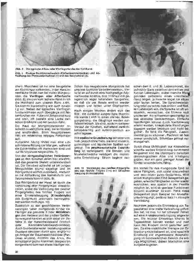 Vorschauseite 3: Kinderheilkunde Vererbte Krankheiten 4. Folge: Das Down-Syndrom (Mongolismus, Trisomie 21)