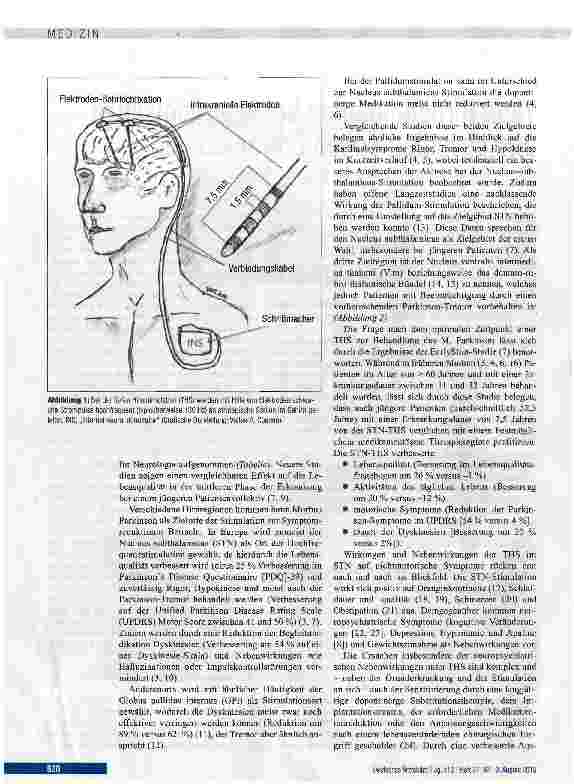 Vorschauseite 2: Tiefe Hirnstimulation bei neurologischen und psychiatrischen Erkrankungen