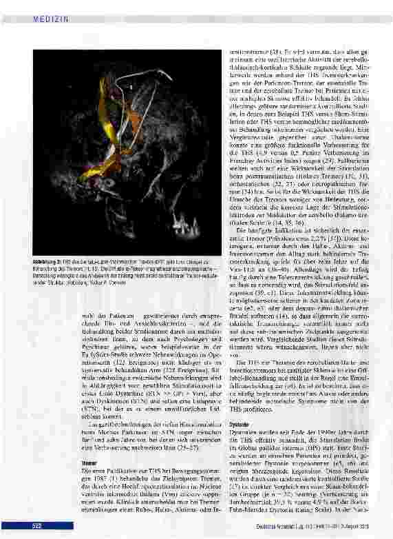 Vorschauseite 4: Tiefe Hirnstimulation bei neurologischen und psychiatrischen Erkrankungen