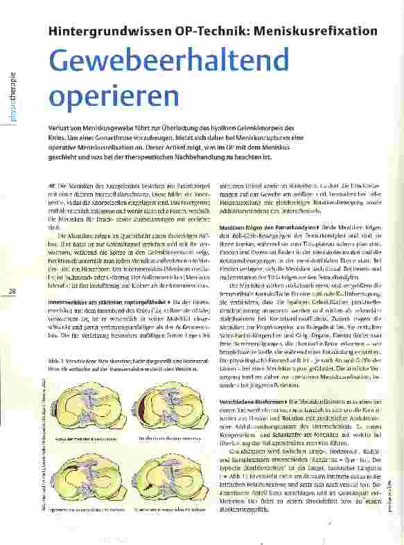 Vorschauseite 1: Hintergrundwissen OP-Technik: Meniskusrefixation Gewebeerhaltend operieren