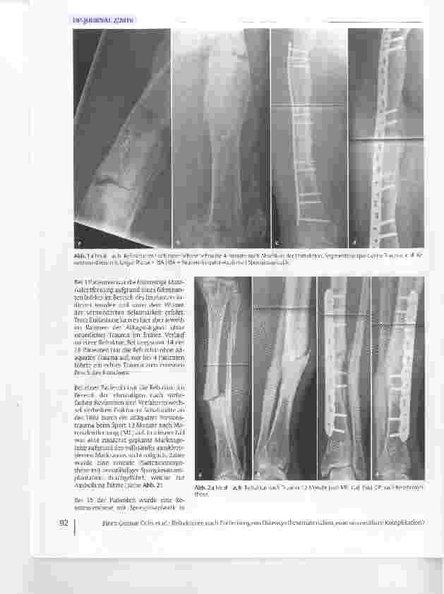 Vorschauseite 3: Refrakturen nach Entfernung von Osteosynthesematerialien, eine vermeidbare Komplikation?