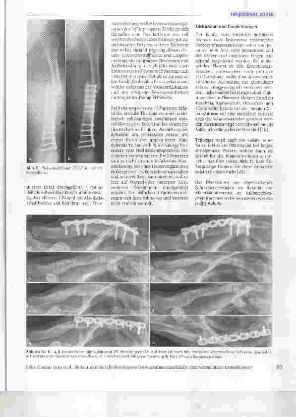 Vorschauseite 4: Refrakturen nach Entfernung von Osteosynthesematerialien, eine vermeidbare Komplikation?
