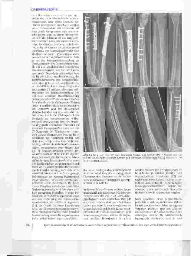 Vorschauseite 5: Refrakturen nach Entfernung von Osteosynthesematerialien, eine vermeidbare Komplikation?