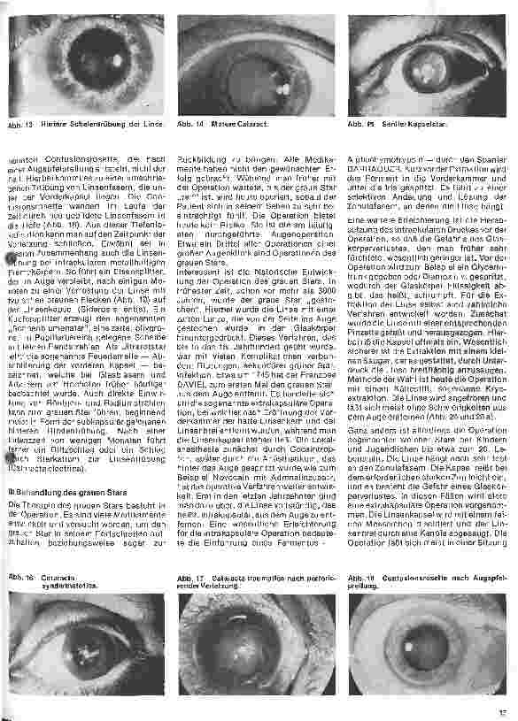 Vorschauseite 4: Einführung in die Augenheilkunde 6. Folge: Erkrankungen der Linse
