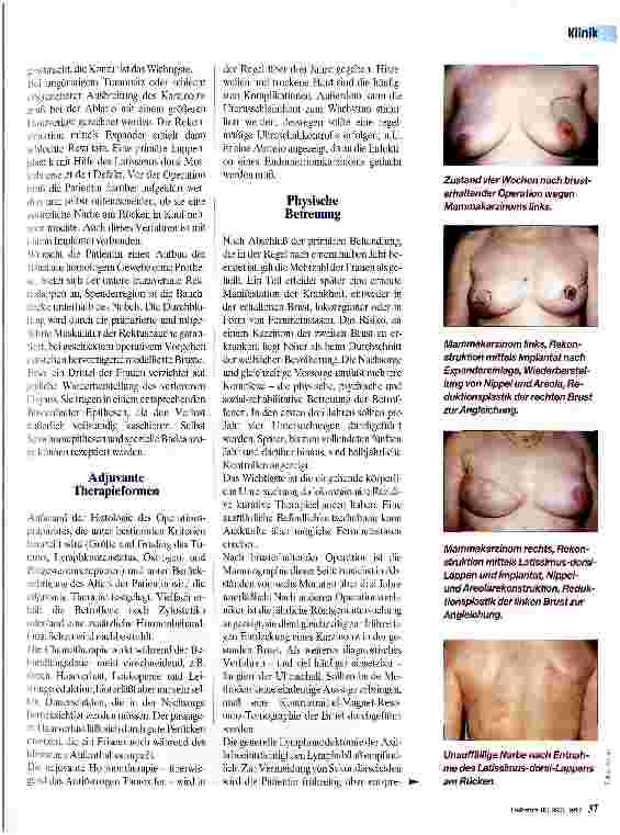 Vorschauseite 2: Mammakarzinom