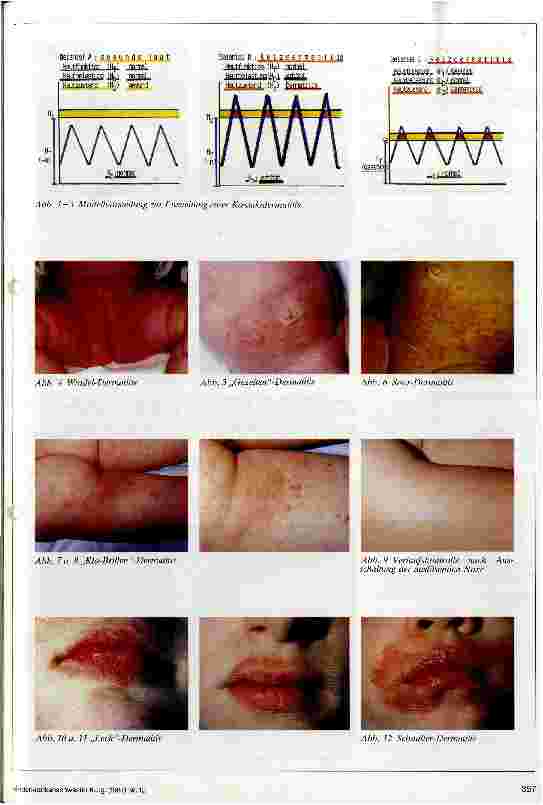 Vorschauseite 2: Kontaktdermatitis Kumulativ-irriative und kumulativ-toxische Kontaktdermatitis