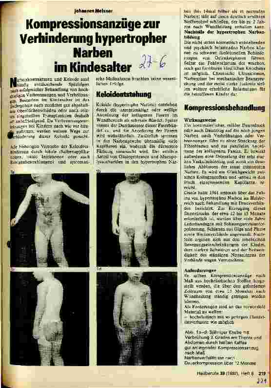 Vorschauseite 1: Kompressionsanzüge zur Verhinderung hypertropher Narben im Kindesalter