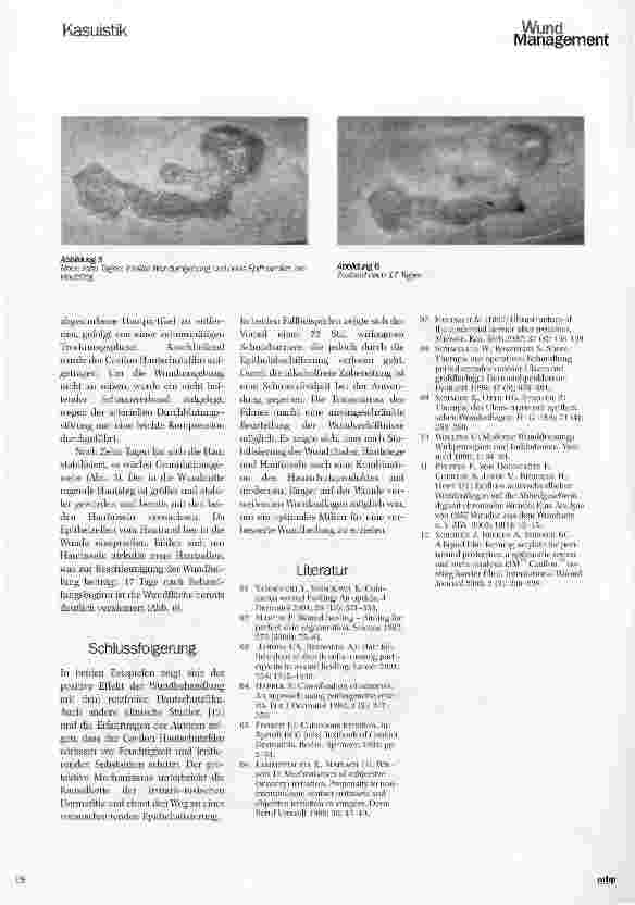 Vorschauseite 4: Die Bedeutung von Hautstegen und Hautinseln und deren Schutz in der Behandlung chronischer Wunden