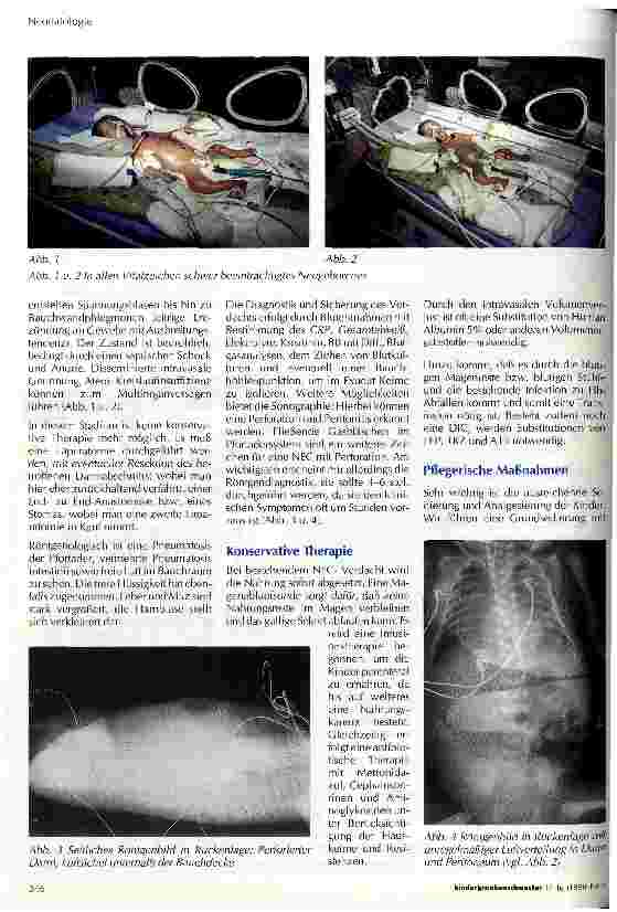 Vorschauseite 2: Nekrotisierende Enterocolitis (NEC), Teil 1 Diagnose, klinisches Bild und pflegerische Maßnahmen
