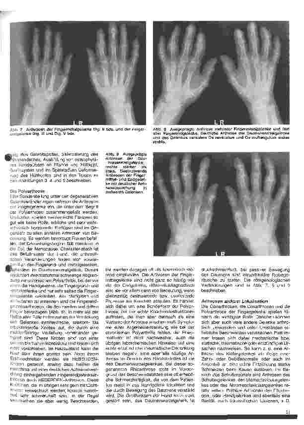 Vorschauseite 4: Rheumatologische Krankheitsbilder 6. Folge: Die Arthrose