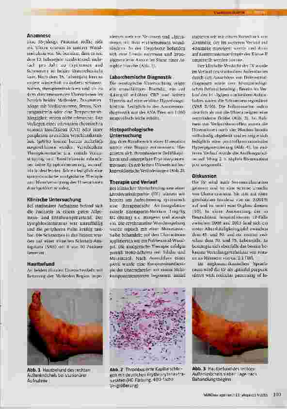Vorschauseite 2: Erstdiagnose einer Livedovaskulopathie nach 40 Jahren und erfolgreiche Therapie mit niedermolekularem Heparin