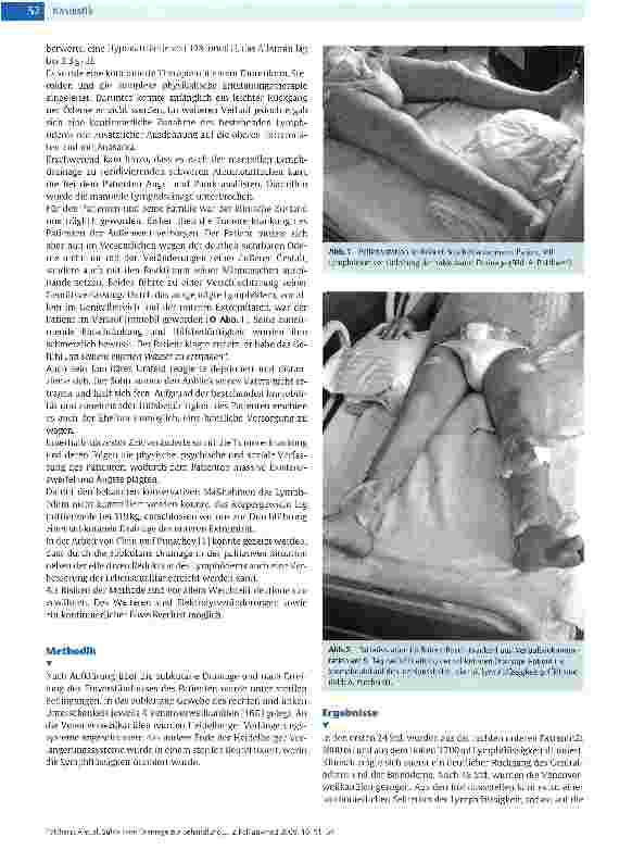 Vorschauseite 2: Subkutane Drainage zur Behandlung des malignen Lymphödems in der Palliativen Situation nach Versagen der komplexen physikalischen Entstauungstherapie