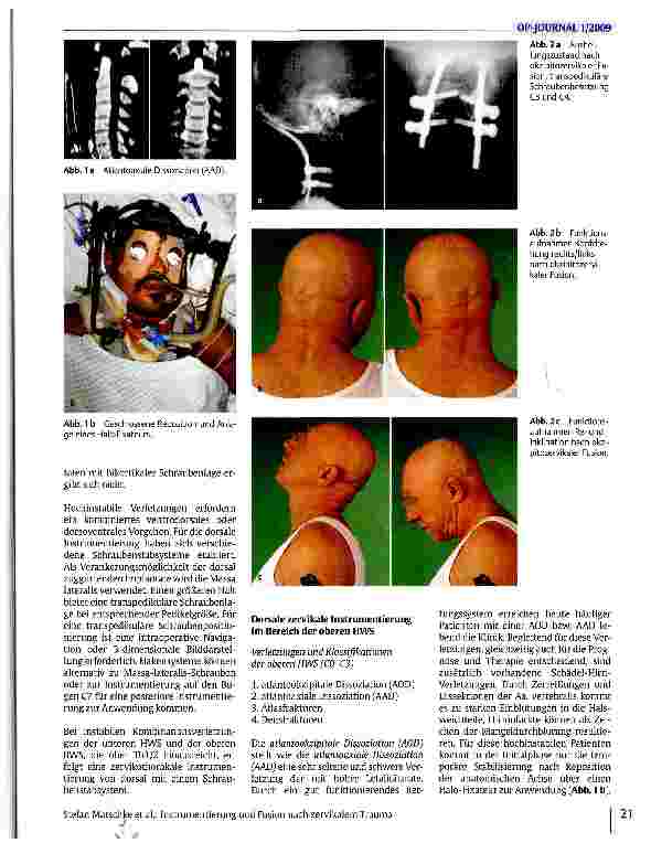 Vorschauseite 2: Instrumentierung und Fusion nach zervikalem Trauma