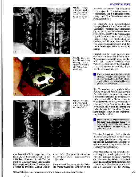 Vorschauseite 6: Instrumentierung und Fusion nach zervikalem Trauma