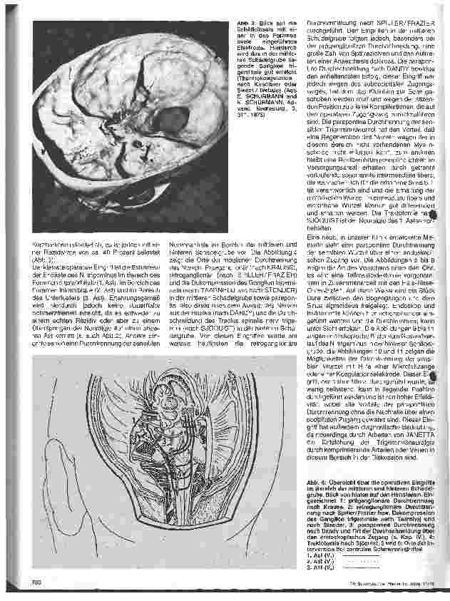 Vorschauseite 3: Die Trigeminusneuralgie Themen aus der Neurochirurgie, 22. Folge