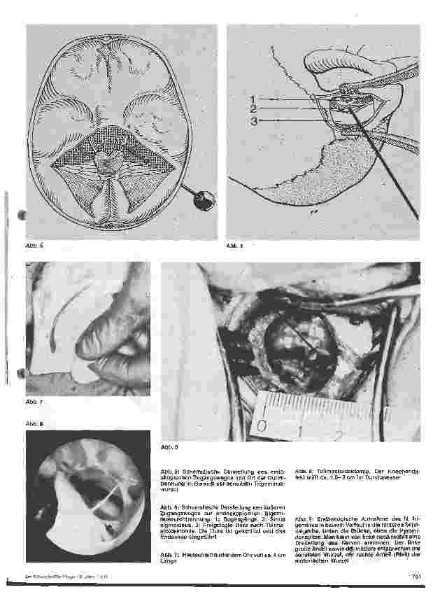 Vorschauseite 4: Die Trigeminusneuralgie Themen aus der Neurochirurgie, 22. Folge