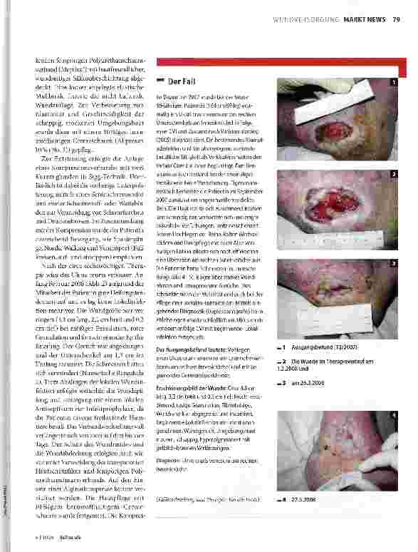 Vorschauseite 2: Wundmanagement eines Ulcus cruris venosum