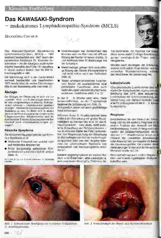 Vorschauseite 1: Das Kawasaki-Syndrom -Mukonkutanes Lymphadenopathie-Syndrom (MCLS)