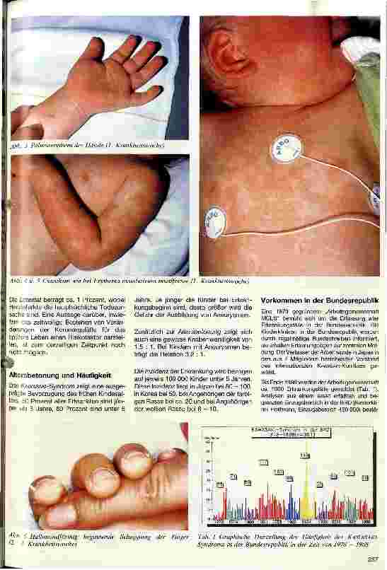 Vorschauseite 2: Das Kawasaki-Syndrom -Mukonkutanes Lymphadenopathie-Syndrom (MCLS)