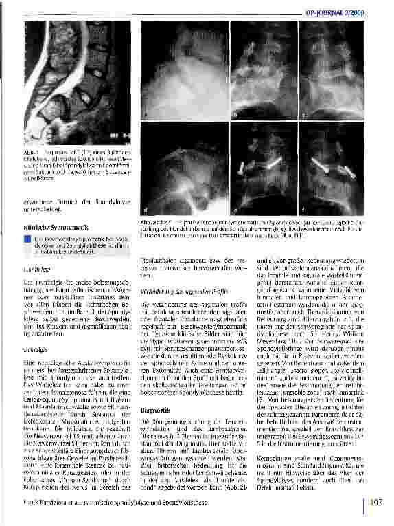 Vorschauseite 2: Isthmische Spondylolyse und Spondylolisthese