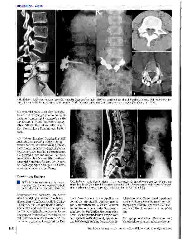 Vorschauseite 3: Isthmische Spondylolyse und Spondylolisthese