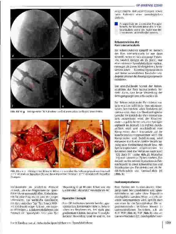 Vorschauseite 4: Isthmische Spondylolyse und Spondylolisthese