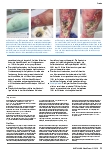 Vorschauseite 4: Studie zeigt Wirksamkeit von Zetuvit Plus Silicone Border beim Exsudatmanagement