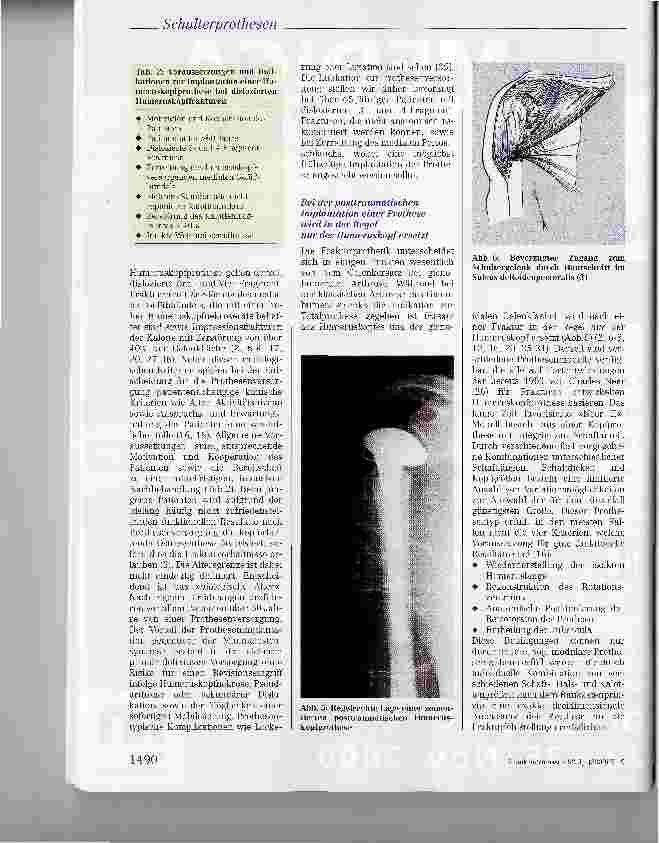 Vorschauseite 4: Posttraumatische Schulterprothesen: Indikation, Technik, Ergebnisse und Rehabilitation