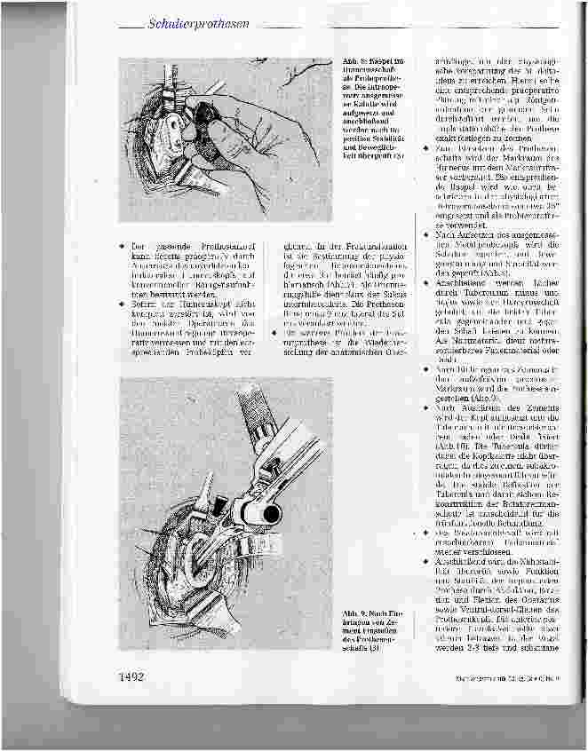 Vorschauseite 6: Posttraumatische Schulterprothesen: Indikation, Technik, Ergebnisse und Rehabilitation