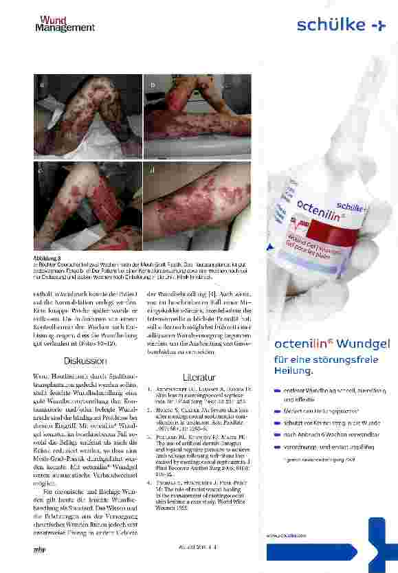 Vorschauseite 3: Kasuistik Meningokokken-Sepsis: Behandlung von hämorrhagischen Hautläsionen mit einem Octenidin-haltigen Wundgel