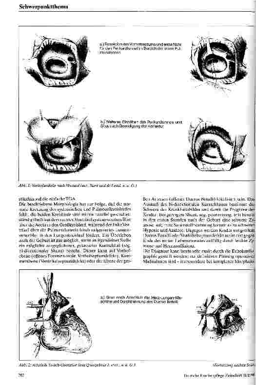 Vorschauseite 2: Die Transposition der großen Arterien