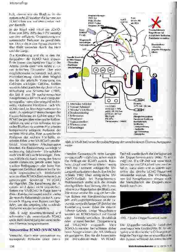 Vorschauseite 4: Extrakorporale Membranoxygenierung (ECMO) beim Neugeborenen