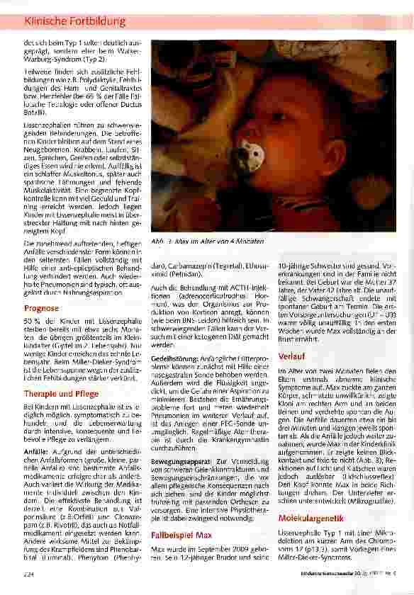 Vorschauseite 2: Lissenzephalie: Das Miller-Dieker-Syndrom