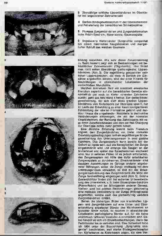 Vorschauseite 2: Angeborene Strangbildungen in der kindlichen Mundhöhle
