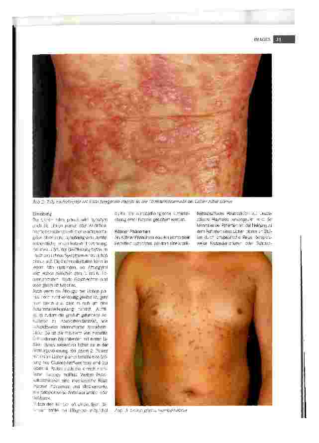 Vorschauseite 2: Wunden bei Lichen ruber planus